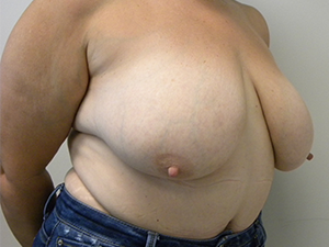 Breast Reduction before and after - before