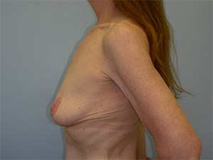 Breast Augmentation before and after - before