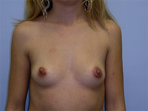 Breast Augmentation before and after - before