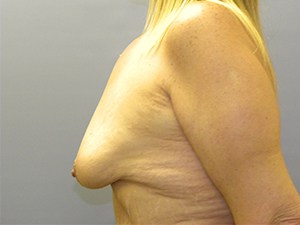 Breast Lift before and after - before