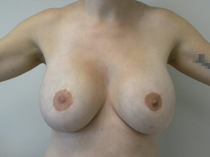Breast Augmentation before and after - before