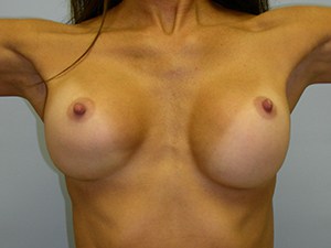 Breast Augmentation before and after - before