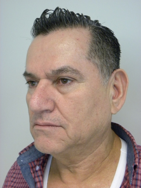 Facelift before and after - before