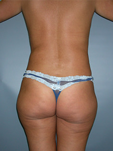 Liposuction before and after - before