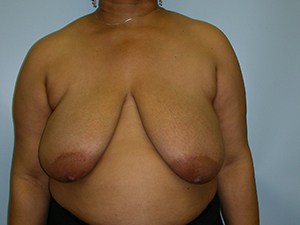 Breast Reduction before and after - before