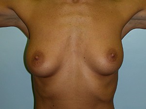 Breast Augmentation before and after - before