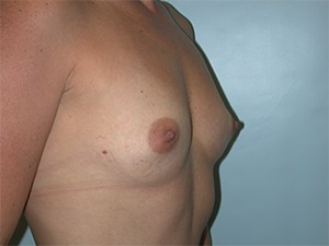 Breast Augmentation before and after - before
