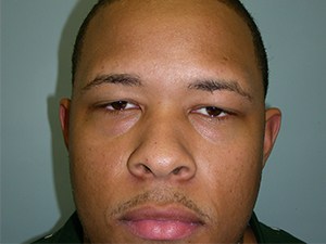 Blepharoplasty before and after - before