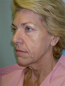 Facelift before and after - before