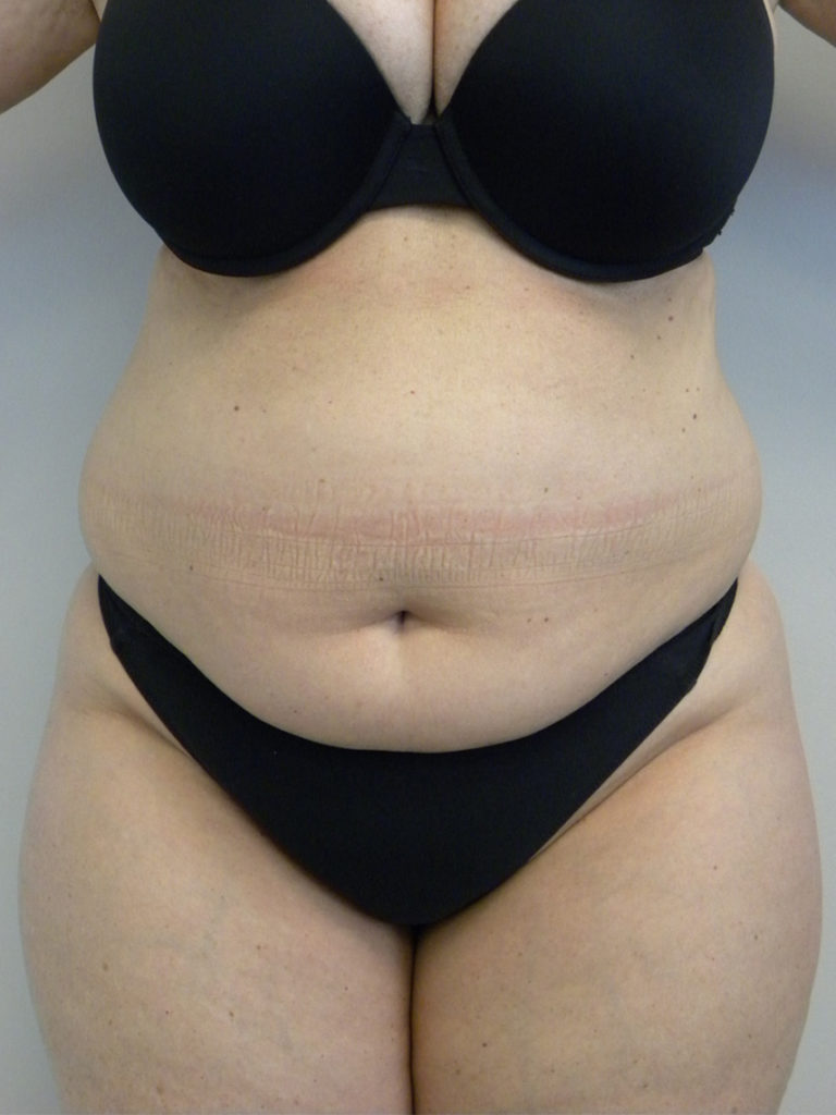 Liposuction before and after - before