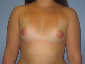 Breast Augmentation before and after - before