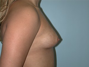Breast Augmentation before and after - before
