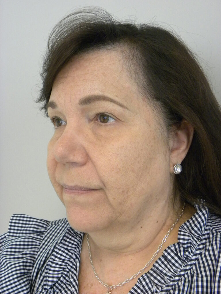 Blepharoplasty before and after - before