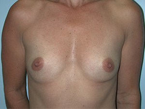Breast Augmentation before and after - before