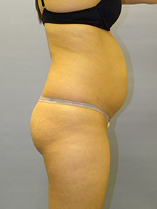 Liposuction before and after - before