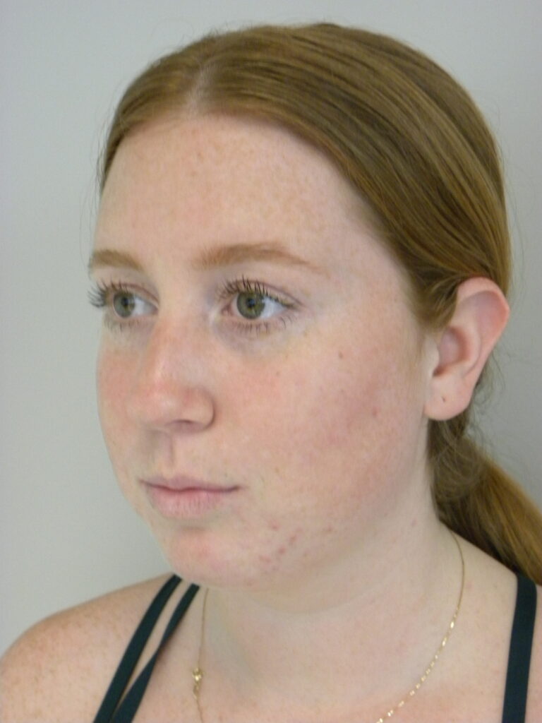 Chin before and after - before
