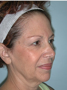 Facelift before and after - before