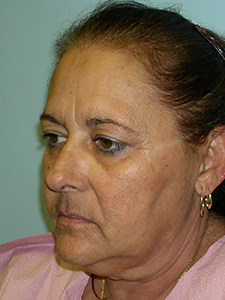 Facelift before and after - before