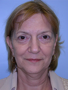 Facelift before and after - before
