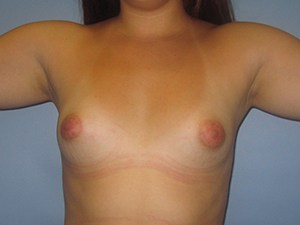 Breast Augmentation before and after - before