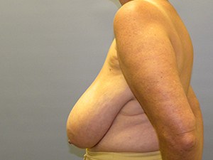 Breast Reduction before and after - before