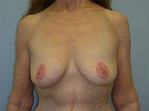 Breast Augmentation before and after - before