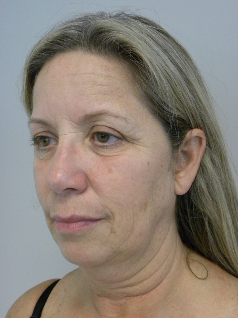 Facelift before and after - before