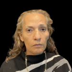 Blepharoplasty before and after - after