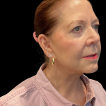 Facelift before and after - after