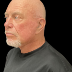 Blepharoplasty before and after - after