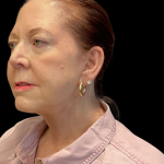 Facelift before and after - after