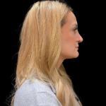 Chin before and after - after