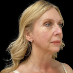 Blepharoplasty before and after - after