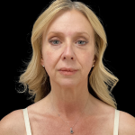Blepharoplasty before and after - after