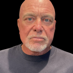 Blepharoplasty before and after - after