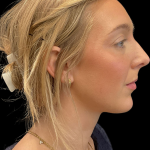 Chin before and after - after