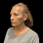Blepharoplasty before and after - after