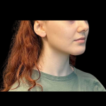 Chin before and after - after
