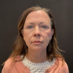 Blepharoplasty before and after - after