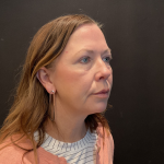 Blepharoplasty before and after - after