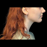 Chin before and after - after