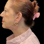 Facelift before and after - after