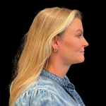 Blepharoplasty before and after - after