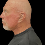 Blepharoplasty before and after - after
