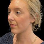 Chin before and after - after