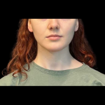 Chin before and after - after