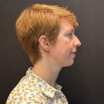 Chin before and after - after
