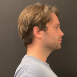 Chin before and after - after