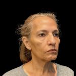 Blepharoplasty before and after - after