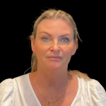 Blepharoplasty before and after - before